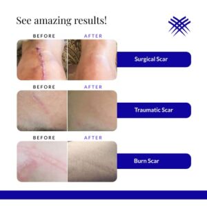 Rejuvaskin RejuvaSil Silicone Scar Gel ? Discreetly Improve the Appearance of Your Scars ? Physician Recommended - 15 mL - Image 6