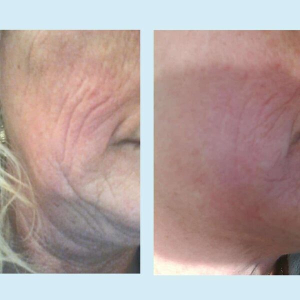 Lactic 50% Gel Peel, Chemical Peels for Face Breakout Scars, Chemical Exfoliant for Face, Strength Level 2, 1.0 fl oz. e, 30 mL ? Perfect Image - Image 3